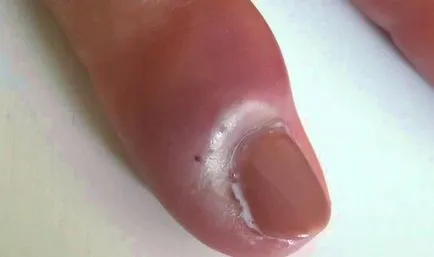 Tratamentul abces pe deget de la picior Tratamentul abces pe deget de la picior