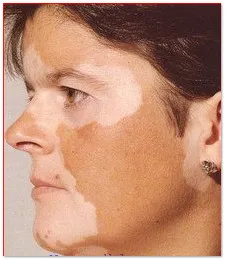 Aceasta stimulează producția de melanină în organism, importanța melaninei