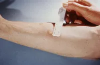 testul DST pentru tuberculoza că este