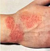 Eczeme - cauze, simptome si remedii populare tratamentul eczemelor (eczeme) Eczema - cauze, simptome si remedii populare eczeme tratament