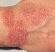 Eczema pe imaginea de tratament mâini, stadiul inițial (inițial) Eczema pe imaginea de tratament mâini, etapa inițială de