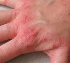 Eczema pe imaginea de tratament mâini, stadiul inițial (tratament) Eczema pe imaginea de tratament mâini, etapa inițială de