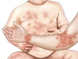 Eczeme - Eczema este vorba
