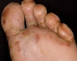 Eczeme - Tratamentul, cauze, simptome, dieta, fotografie (eczeme) Eczeme - tratament, cauze, simptome, dieta, fotografii