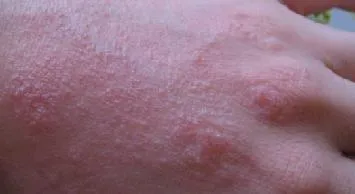 Eczema pe imaginea de tratament mâini, stadiul inițial (mâini) Eczema pe imaginea de tratament mâini, etapa inițială de