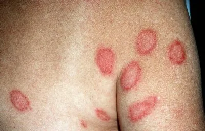 Eczema - Tipuri, cauze, simptome, dieta si tratament (eczeme cauze simptome plângătoare microbiene seboreica adevarat atopica disgidroticheskaya profesionale uscat -ca tratament) Eczemă - Tipuri, cauze, simptome, dieta si tratament