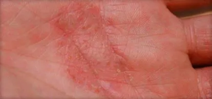 Eczeme pe mâini decât pentru a vindeca, cele mai bune mijloace (unguente, creme, tablete, injecții și rețete tradiționale)