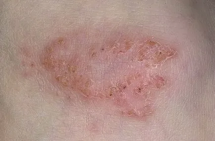 Eczema - Tipuri, cauze, simptome, dieta si tratament (eczeme cauze simptome plângătoare microbiene seboreica adevarat atopica disgidroticheskaya profesionale uscat -ca tratament) Eczemă - Tipuri, cauze, simptome, dieta si tratament