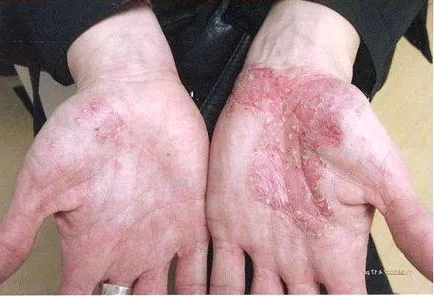 Eczeme pe mâini decât vindecarea, medicamente, comentarii