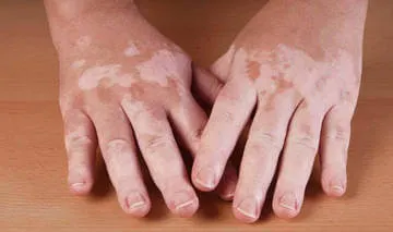 Hormonul melatonină și melanina pigment - diferența (hormon) Hormonul melatonină și melanina pigmentul - ceea ce este diferența