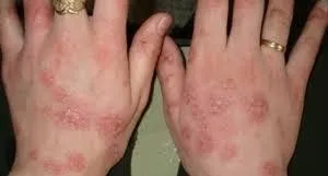 Cum de a trata eczeme a mainilor pe medicamente eficiente și remedii populare (mijloace) Cum de a trata eczeme pe mâinile unor medicamente eficiente și remedii populare