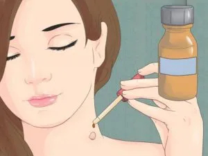 Cum de a trata papilomavirus uman cele mai eficiente metode de (tratate) Cum de a trata papilomavirus uman cele mai eficiente metode