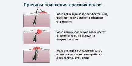 Cum se utilizează epilatorului care nu a durut (a avut) Cum să utilizați epilatorului pentru a evita rănirea