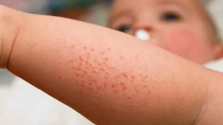 Cum știi că copilul are o alergie la detergent de rufe (pulbere) Cum știi că copilul are o alergie la praf de spălat