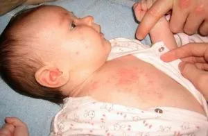 Cum sunt alergic la pulberea la sugari (alergie praf de spălat) Cum sunt alergic la pulberea la sugari