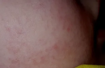 Cum o alergie la praf de spălat, alergie opri