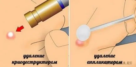 Cum de a elimina Clinica papiloma si remedii populare
