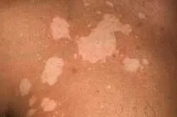 Ce este Impetigo la oameni - patogeni privând, cauze, simptome, alfabet de sănătate (stripping) Ce este Impetigo la oameni - patogeni privând, cauze, simptome, alfabet de sănătate
