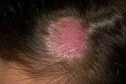 Ce este Impetigo la oameni - patogeni privând, cauze, simptome, alfabet de sănătate (stripping) Ce este Impetigo la oameni - patogeni privând, cauze, simptome, alfabet de sănătate