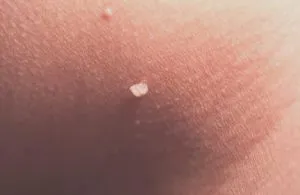 Cum de a afișa papiloma acasă căi de atac populare