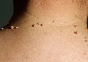 Cum de a afișa papiloma acasă căi de atac populare