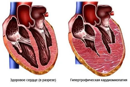 Cardio pentru inima, antrenament cardio pentru inima, cardio pentru a consolida inima, exercitii cardio (ritm cardiac tulburări) Cardio pentru inima, antrenament cardio pentru inima, cardio pentru a consolida inima, antrenament cardio