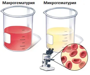 Sânge în urină - diagnostic și tratament