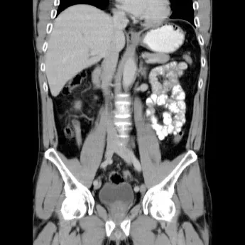 CT abdominal care arată prepararea CT cu substanță de contrast și preț (formare) CT abdominal care arată prepararea CT cu substanță de contrast și preț