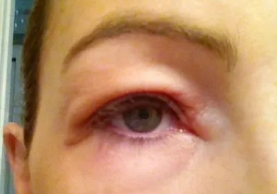Tratamentul de ochi edem ce să facă atunci când o inflamație alergică și roșeață (ochii umflati) tratament edem ocular ce să facă atunci când o inflamație alergică și roșeață