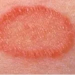 Versicolor precum și decât pentru a trata simptomele de specii de licheni și licheni