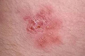 Pecingine în fotografie om, semne, simptome de tratament, decât pentru a trata herpesul zoster (herpes la om) Pecingine în om fotografie, semne, tratament, simptome decât pentru a trata scabia