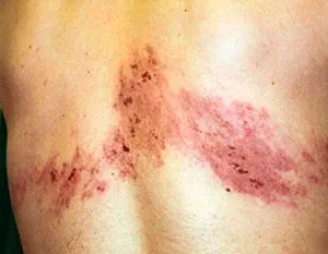 Pecingine în fotografie om, semne, simptome de tratament, decât pentru a trata herpesul zoster (uman) Pecingine în om fotografie, semne, tratament, simptome decât pentru a trata scabia