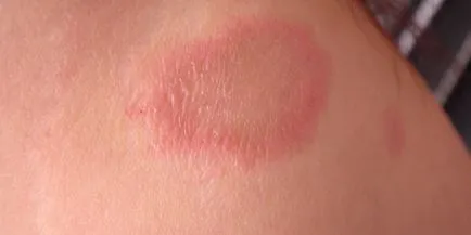 Pecingine simptomelor oameni, tipuri și etapele de boli ale pielii, cauzele și diagnosticare
