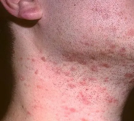manifestări impetigo Gibert, diagnosticul, tratamentul metodelor tradiționale (Gibert) Zoster Gibert manifestări, diagnostic și tratament al metodelor tradiționale