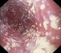 Sturz - cauze, simptome, diagnostic și tratament