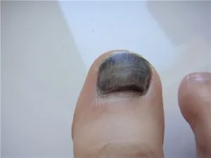 Pe picioarele sale sunt unghiile negre ce să facă și de ce se întâmplă