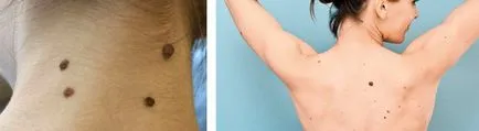 Corp mai multe cauze de birthmarks, tipuri de nevus, atunci când pentru a merge la medic, fotografie