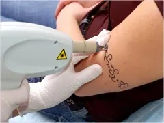 Despre tatuaje dintr-un punct de vedere medical Despre tatuaje dintr-un punct de vedere medical
