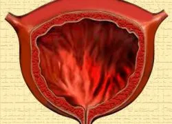 urina cistita acuta cu sânge (cistite) cistita acuta de urina cu sange