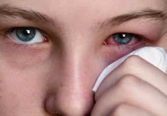 ochii umflati si pleoapa superioara pentru a face acest lucru după umflarea lacrimi