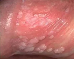 papilomavirus uman - simptome, tratament, prevenire