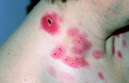 papilomavirus uman - simptome, prevenire, tratament