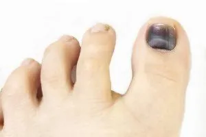 De ce unghiile de la picioare înnegrite - viața mea De ce unghiile de la picioare înnegrite - viața mea