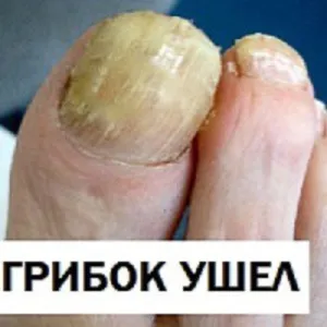 De ce înnegrite de unghii pe degetul mare