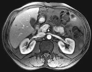 Pregătirea pentru o procedură IRM, complexitatea cavității abdominale