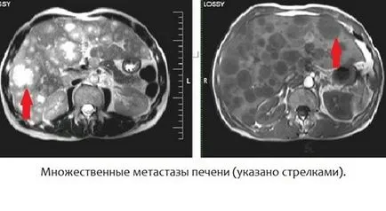 Pregătirea pentru caracteristicile IRM abdominale, care trebuie să acorde o atenție Pregătirea pentru caracteristicile IRM abdominale, care trebuie să acorde o atenție