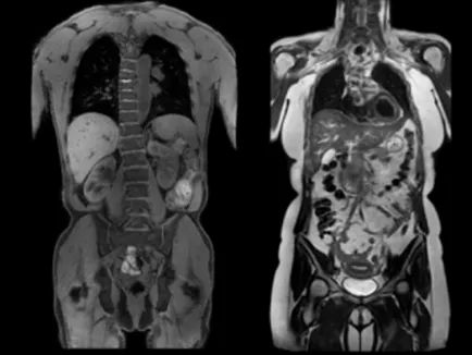 Pregătirea pentru RMN a cavității abdominale și organele spațiului peritoneal (preparare) Pregătirea pentru RMN a cavității abdominale și a organelor de spațiu peritoneală