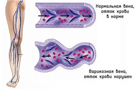 Cauze, simptome și simptome tromboză, modul de a trata tromboza și posibilele consecințe