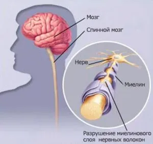 Mai multe căi de atac de tratament populare scleroză, cauzele de sex feminin (remedii de tratament populare) Tratamentul sclerozei multiple de remedii populare, cauzele femeilor