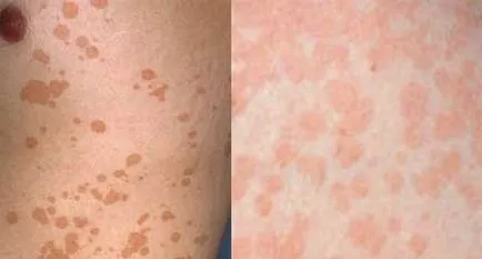 Pitiriazis versicolor - fotografie la om, tratament, medicamente
